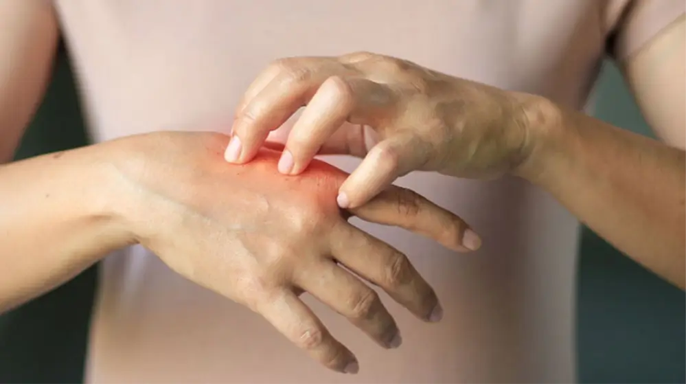 Грибкові інфекції